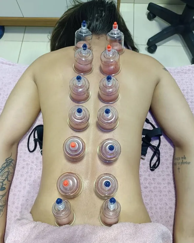 Ventosas aplicadas ao longo das costas de uma paciente